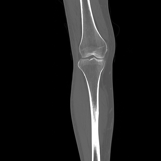NCCT Right Knee Joint